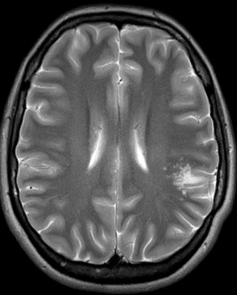 Shingo_Omata's tweet photo. <What’s your diagnosis?>

👤 30s Male 
📋 Recent onset of seizures. Rule out structural abnormality. 

#Rdiag #MedEd #RadEd #NeuroRad #FOAMrad #FOAMed https://t.co/OZqNBT7qli