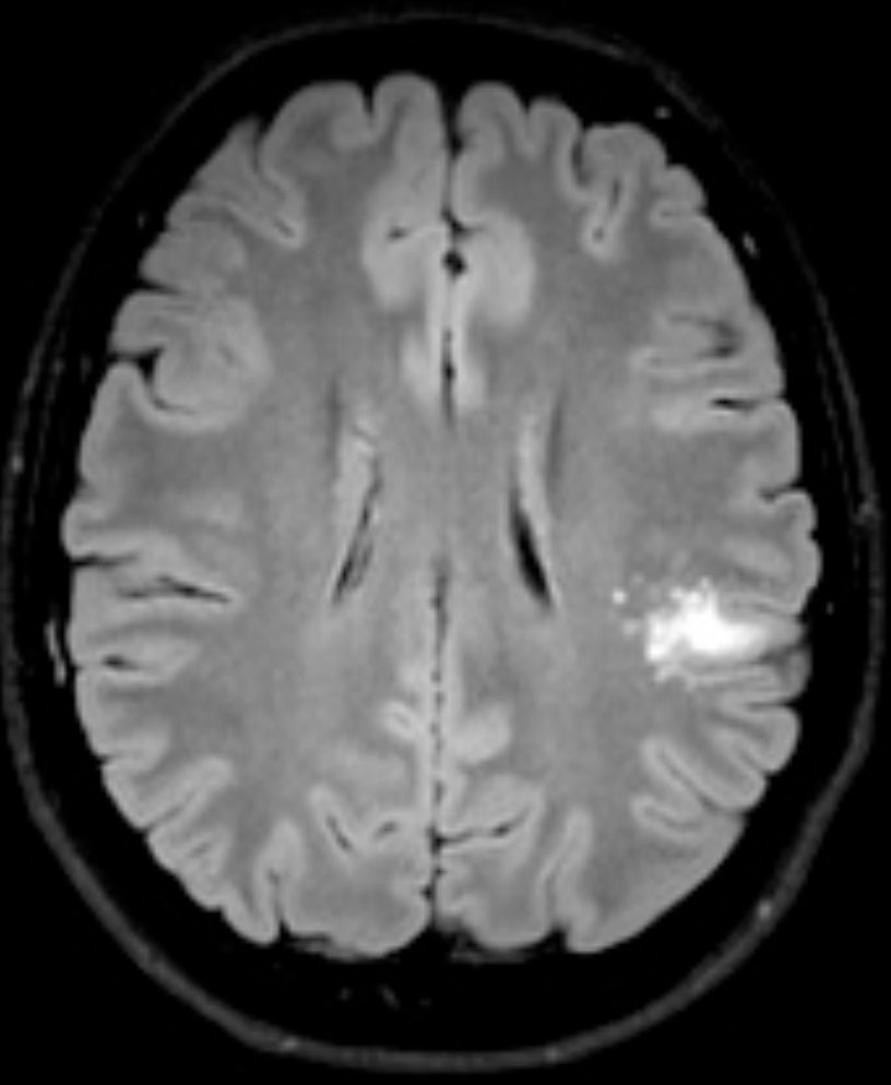 Shingo_Omata's tweet photo. <What’s your diagnosis?>

👤 30s Male 
📋 Recent onset of seizures. Rule out structural abnormality. 

#Rdiag #MedEd #RadEd #NeuroRad #FOAMrad #FOAMed https://t.co/OZqNBT7qli
