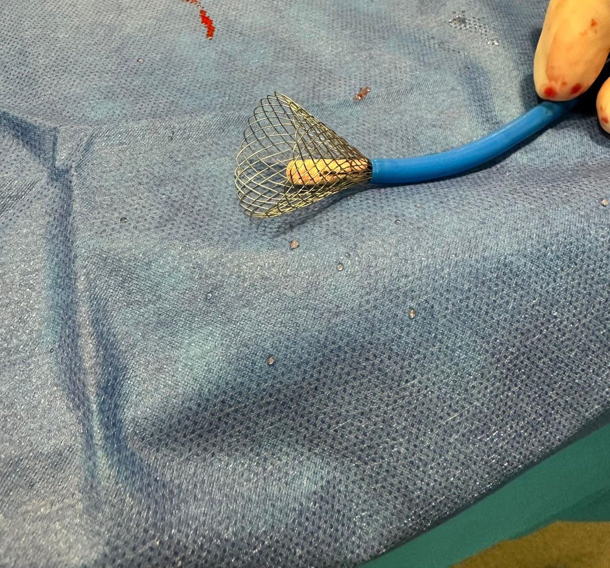 aelsab's tweet image. Loose tricuspid SLDA? ONO facilitated retrieval: jacc.org/doi/10.1016/j.… 

ONO basket allows stand up of snared clip vertically allowing smooth retrieval into sheath without getting stuck perpendicularly at sheath entry/injury to vein @SinaOSullivan @mirvatalasnag @DrPeterPollak