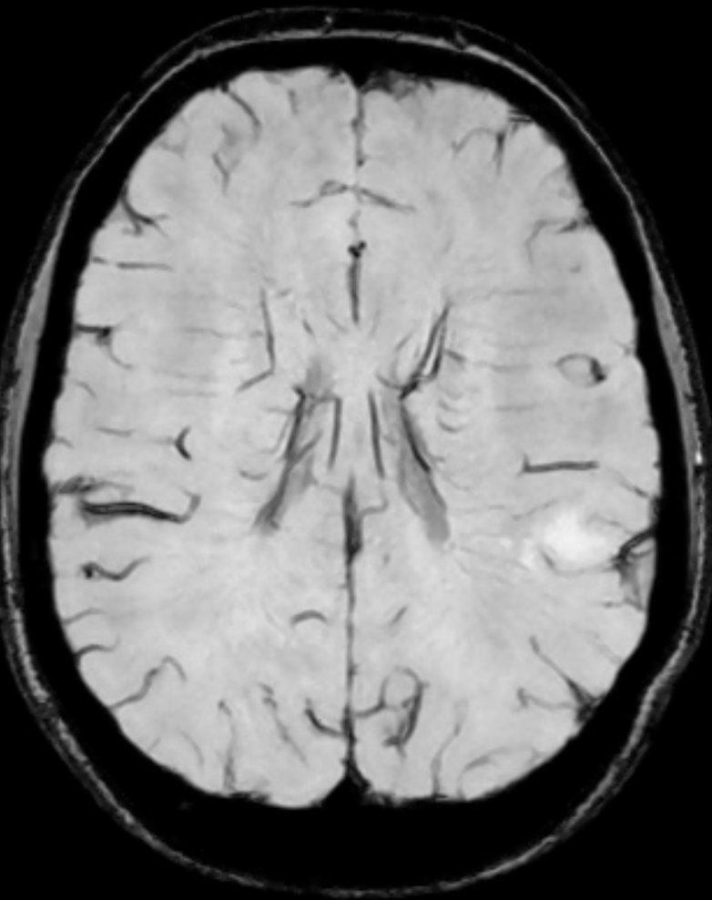 Shingo_Omata's tweet photo. <What’s your diagnosis?>

👤 30s Male 
📋 Recent onset of seizures. Rule out structural abnormality. 

#Rdiag #MedEd #RadEd #NeuroRad #FOAMrad #FOAMed https://t.co/OZqNBT7qli