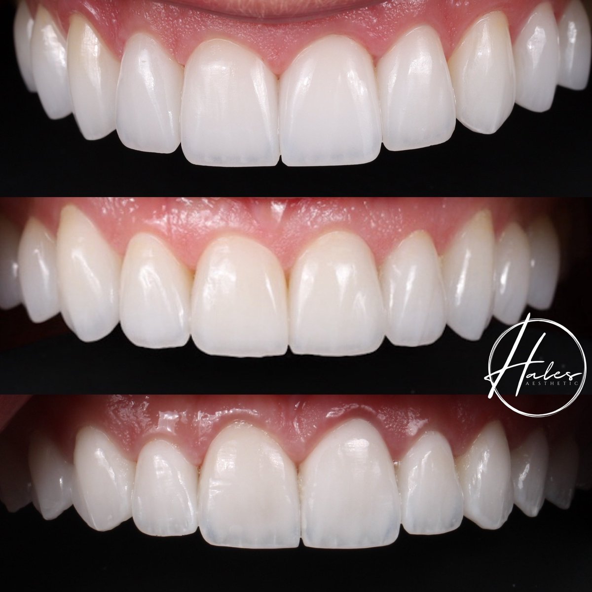 Not all smiles are created equal — and that’s precisely what sets Harmony Veneers apart. Each smile is meticulously custom-designed, with every detail thoughtfully considered.