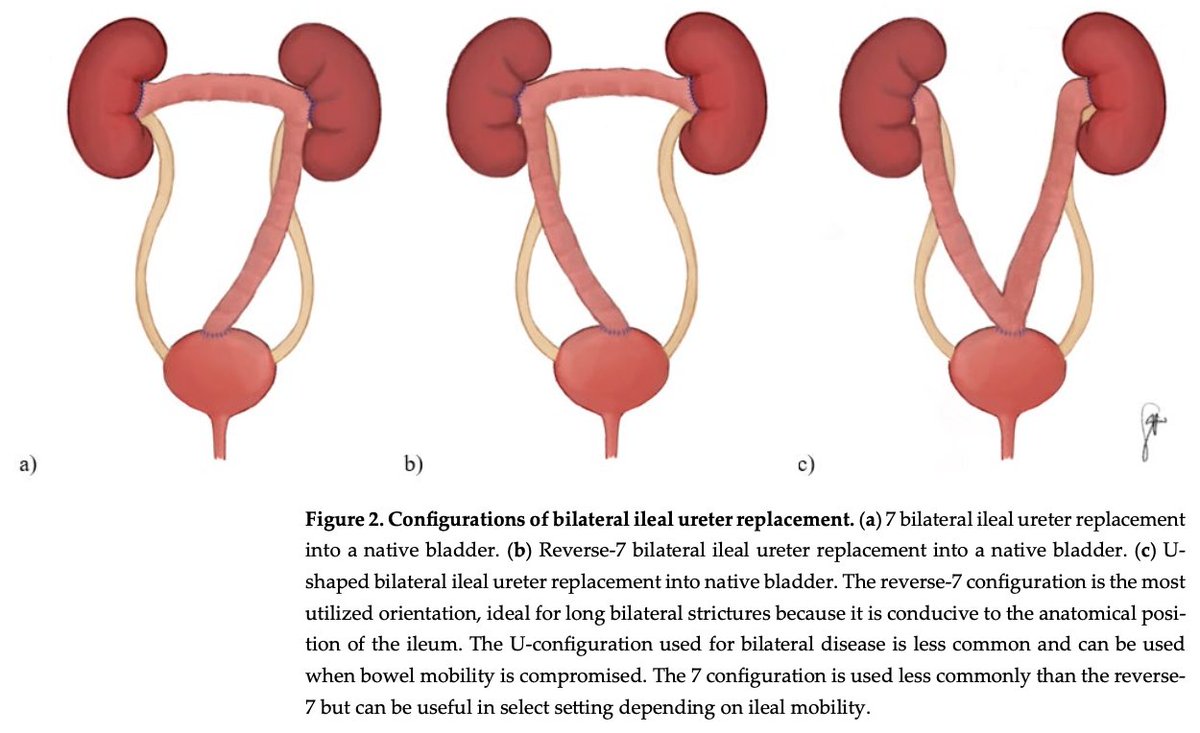 Sasha Vereecken (@sjvereeck) on Twitter photo 🚨 Just published!
Explore the evolution of ileal ureteral reconstruction from its origins to modern robotic-assisted techniques
📖 doi.org/10.3390/uro502…
Pleasure working with <a href="/Brian_J_Flynn/">Brian J. Flynn, M.D.</a> team (<a href="/NigroNoah/">Noah N. Nigro, M.D.</a>, <a href="/kdoersch689/">Karen</a>, <a href="/RohanBhallaMD/">Rohan Bhalla</a> & others) <a href="/CU_Urology/">CU Urology</a>! #UroSoMe 🚨 Just published!
Explore the evolution of ileal ureteral reconstruction from its origins to modern robotic-assisted techniques
📖 doi.org/10.3390/uro502…
Pleasure working with <a href="/Brian_J_Flynn/">Brian J. Flynn, M.D.</a> team (<a href="/NigroNoah/">Noah N. Nigro, M.D.</a>, <a href="/kdoersch689/">Karen</a>, <a href="/RohanBhallaMD/">Rohan Bhalla</a> & others) <a href="/CU_Urology/">CU Urology</a>! #UroSoMe