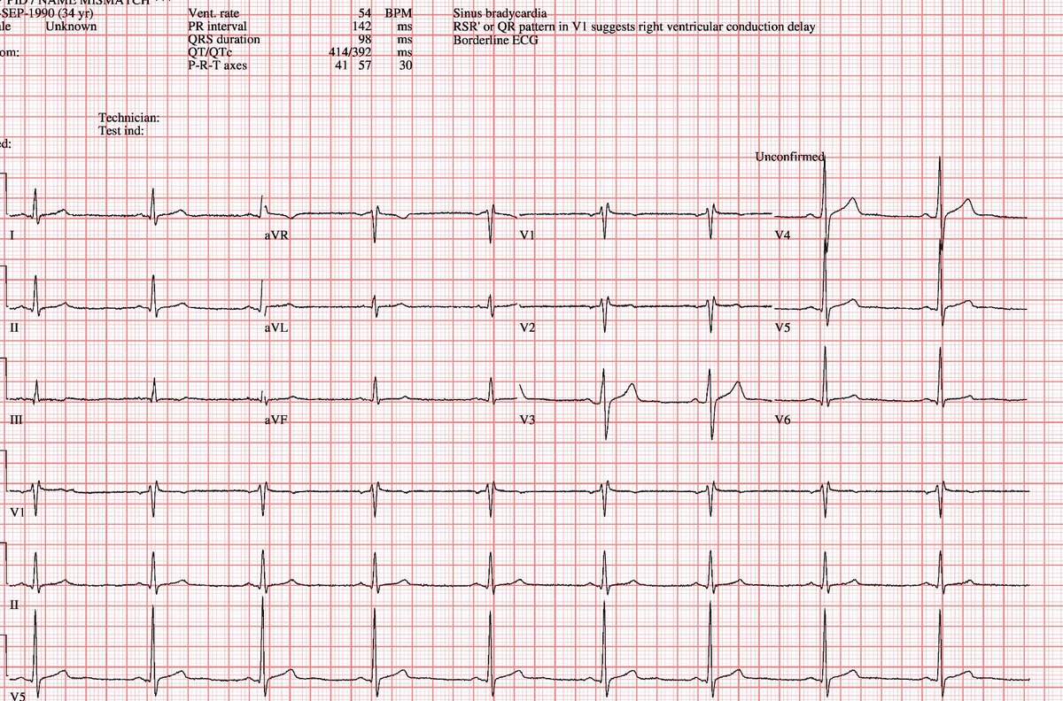 34-year-old male, s/p hypertension, admitted with  onset of chest pain that resolved after initial measures. Following diagnosis of ACS (non-ST elevation MI).  Mild troponin increase . EKG above.

Follow the 🧵.

🔍 Curious to know how you would handle this case?
