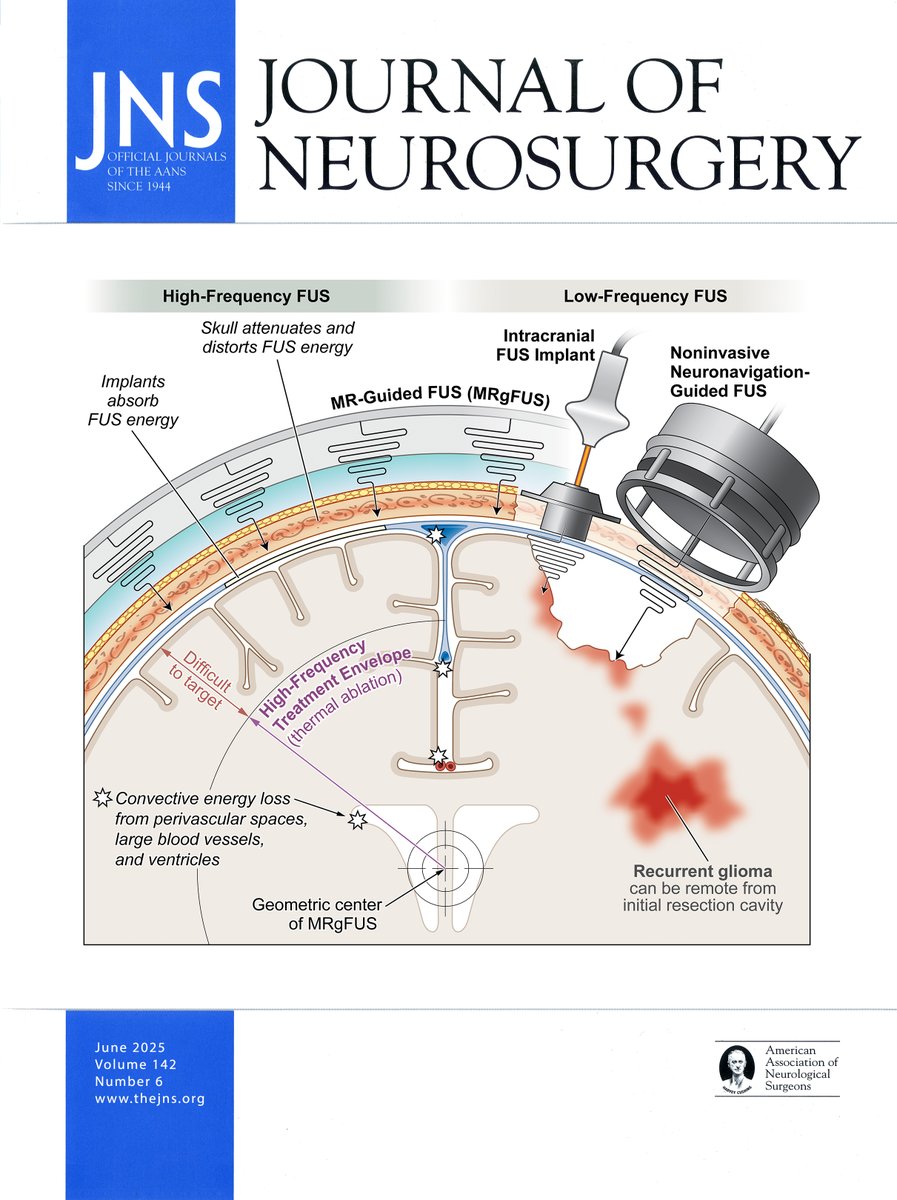 UCSF Neurosurgery (@neurosurgucsf) on Twitter photo On the cover of @theJNS, <a href="/jakeyoung11/">Jake Young, MD</a>, <a href="/J_deGrootMD/">John de Groot, MD</a>, <a href="/ManishKAghi/">Manish Aghi, MD PhD</a> & colleagues review the role of focused ultrasound (FUS) in treating gliomas and highlight how low-frequency FUS can temporarily disrupt the blood-brain barrier to enhance drug delivery: thejns.org/view/journals/⦠On the cover of @theJNS, <a href="/jakeyoung11/">Jake Young, MD</a>, <a href="/J_deGrootMD/">John de Groot, MD</a>, <a href="/ManishKAghi/">Manish Aghi, MD PhD</a> & colleagues review the role of focused ultrasound (FUS) in treating gliomas and highlight how low-frequency FUS can temporarily disrupt the blood-brain barrier to enhance drug delivery: thejns.org/view/journals/ā¦
