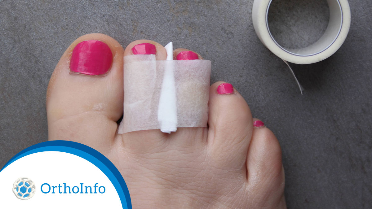 AAOS1's tweet photo. .@Mets star Mookie Betts is nursing a #toefracture after stubbing the toe at home. Learn some signs that an injured toe might be broken and get first aid tips to use while you're waiting to see a doctor at #OrthoInfo: https://t.co/dGBaRss9qr #Orthotwitter @MLB @aossm1972 @AOFAS https://t.co/UeALzz2Ca2