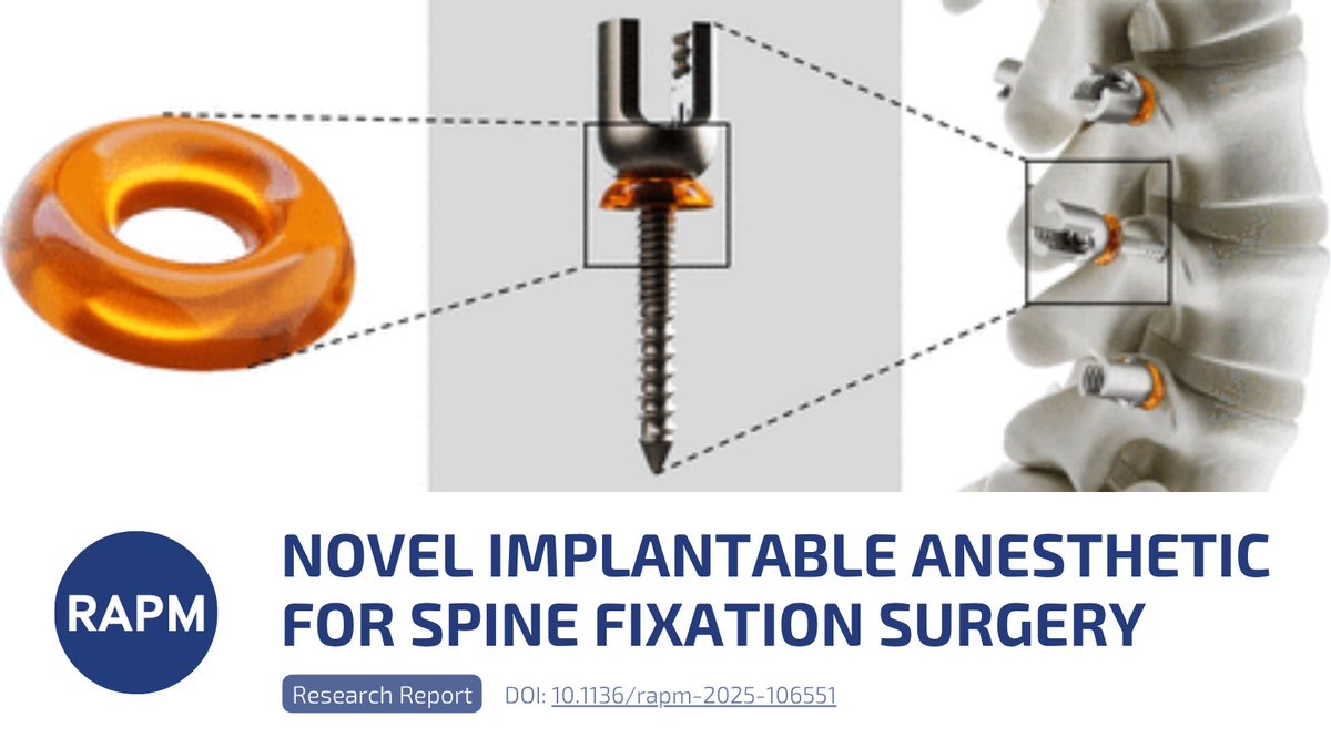 🚀 Next-Level Spine Surgery Pain Management is Here!

Meet BR-003: an implantable hydrogel delivering local anesthetic for 3+ days around pedicle screws in spine surgery.

Early trials show:
safe drug levels
no serious side effects
no impact on implants. 

doi.org/10.1136/rapm-2…