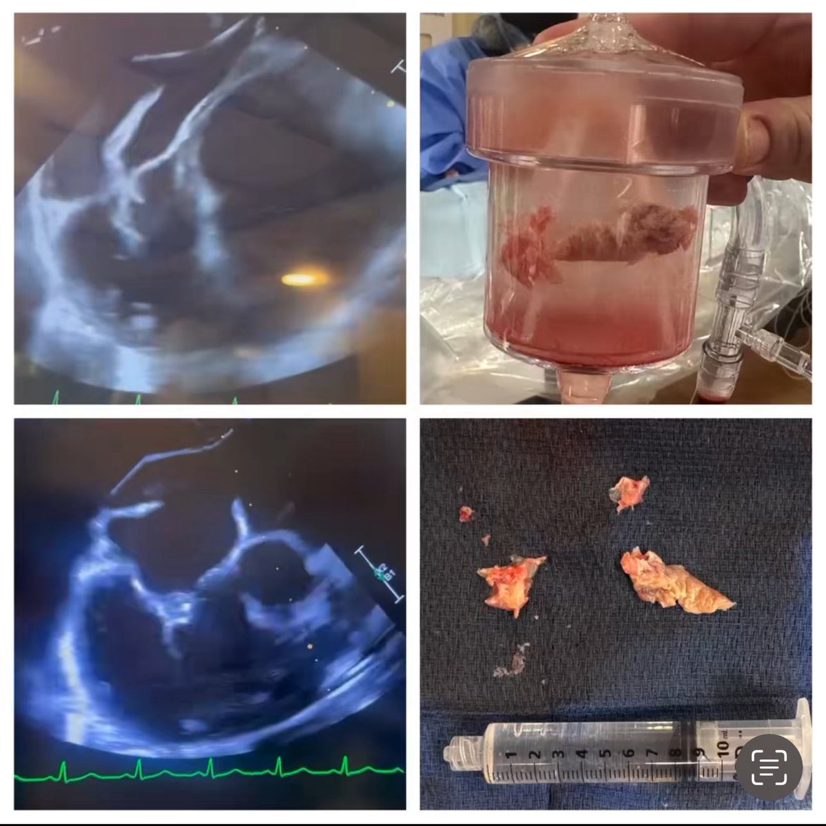 Kristen N. Brown, MD🫀 (@kristen_brownmd) on Twitter photo #ANGIOVAC Vegetectomy of the Tricuspid Valve <a href="/PrincetonBMC/">princetonbaptist</a> in #Birmingham, AL for dubulking of tricuspid valve endocarditis #ANGIOVAC Vegetectomy of the Tricuspid Valve <a href="/PrincetonBMC/">princetonbaptist</a> in #Birmingham, AL for dubulking of tricuspid valve endocarditis