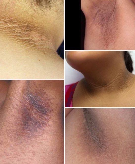 meinmokhtar's tweet photo. Tips nak hilangkan hitam dekat pelipat :

1. Cut sugar 
2. Glycolic Acid 

Pakai je glycolic acid seminggu 2-3 kali dah boleh dapat kulit cerah sebab daki &amp; kulit mati dah tanggal! 💯✨✨ https://t.co/JqVd6Rb15G