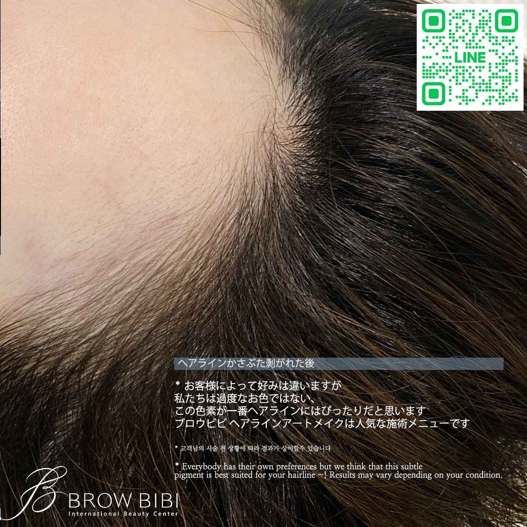 browbibi_main's tweet photo. 気になる生え際、
そっと自然に整えてみませんか？🩷
ヘアラインアートメイクでより自分らしく、美しく✨
まずはご相談からお気軽にどうぞ📩
#眉毛アート #韓国メイクアップ #眉アートメイク #韓国アートメイク #韓国コスメ #アートメイク眉 #渡韓 #韓国旅行情報 #ヘアラインアートメイク https://t.co/Qq9cYs2Ylr
