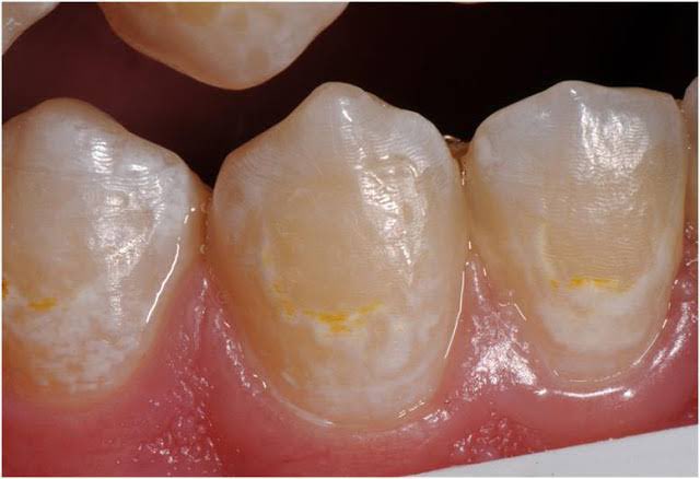 ib_shah's tweet photo. Pernah nampak tompok putih dekat gigi, especially dekat tepi gusi?
Macam chalky, opaque putih?
Kalau ya… tu bukan sekadar stain. That might be your teeth crying for help 😬 https://t.co/SHW2g6JUiG