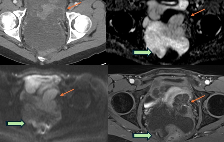 Samvid Kotia, MD (@kotiasamvid) on Twitter photo 1/ Came across a striking case of pseudomyxoma peritonei (PMP) — followed it up this phenomenal <a href="/RadioGraphics/">RadioGraphics</a> article doi.org/10.1148/rg.240…. Sharing key takeaways and case images in this thread. 🧵👇
#Radiology #MedTwitter #RadEd #FOAMRad 1/ Came across a striking case of pseudomyxoma peritonei (PMP) — followed it up this phenomenal <a href="/RadioGraphics/">RadioGraphics</a> article doi.org/10.1148/rg.240…. Sharing key takeaways and case images in this thread. 🧵👇
#Radiology #MedTwitter #RadEd #FOAMRad