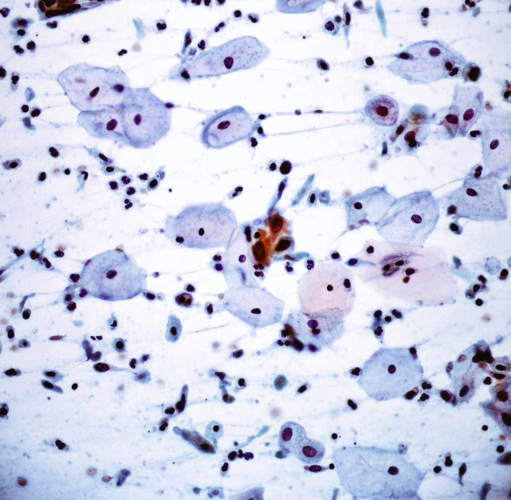 Citopatoroxx's tweet image. -Very cellular smear with a subtle background tumor diathesis. 
-Markedly hyperchromatic nuclei with granular irregular chromatin.
-Abnormal keratinized cells, bizarre and spindle-shaped. 

Squamous cell carcinoma. 

#paptest #cytopath #cytology