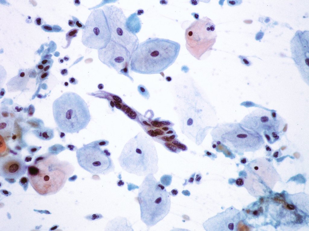 Citopatoroxx's tweet image. -Very cellular smear with a subtle background tumor diathesis. 
-Markedly hyperchromatic nuclei with granular irregular chromatin.
-Abnormal keratinized cells, bizarre and spindle-shaped. 

Squamous cell carcinoma. 

#paptest #cytopath #cytology