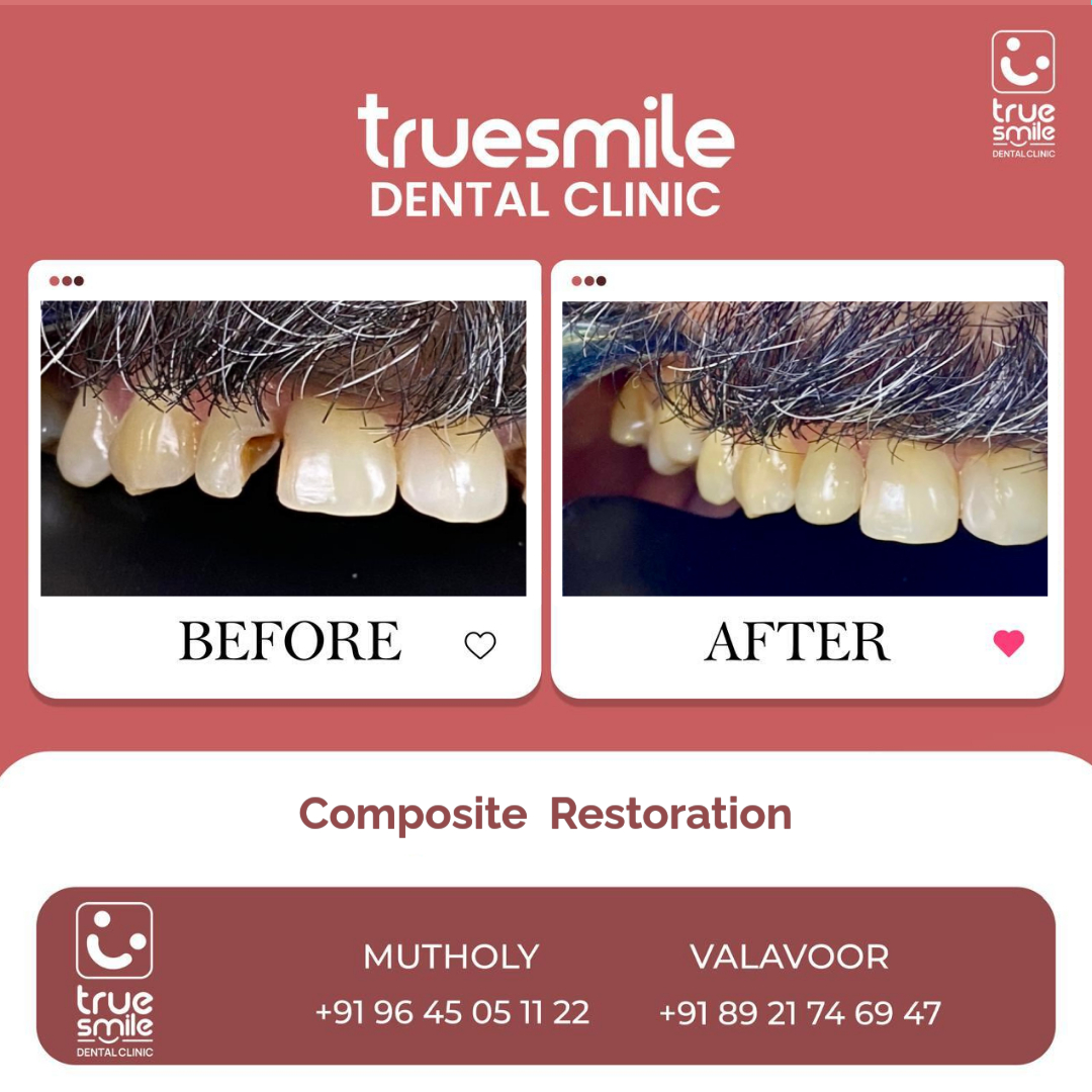 True Smile Dental Clinic (@clinictrue) on Twitter photo ๐ฆทโจ ๐๐๐๐๐๐๐๐๐ ๐๐๐๐๐๐๐๐๐๐๐ โ ๐๐๐ฌ๐ญ๐จ๐ซ๐ ๐๐จ๐ฎ๐ซ ๐๐ฆ๐ข๐ฅ๐, ๐๐๐ญ๐ฎ๐ซ๐๐ฅ๐ฅ๐ฒ! โจ๐ฆท
Chipped tooth? Small cavity? Uneven edges? Donโt worry, composite restorations have you covered! ๐ซ ๐ฆทโจ ๐๐๐๐๐๐๐๐๐ ๐๐๐๐๐๐๐๐๐๐๐ โ ๐๐๐ฌ๐ญ๐จ๐ซ๐ ๐๐จ๐ฎ๐ซ ๐๐ฆ๐ข๐ฅ๐, ๐๐๐ญ๐ฎ๐ซ๐๐ฅ๐ฅ๐ฒ! โจ๐ฆท
Chipped tooth? Small cavity? Uneven edges? Donโt worry, composite restorations have you covered! ๐ซ
