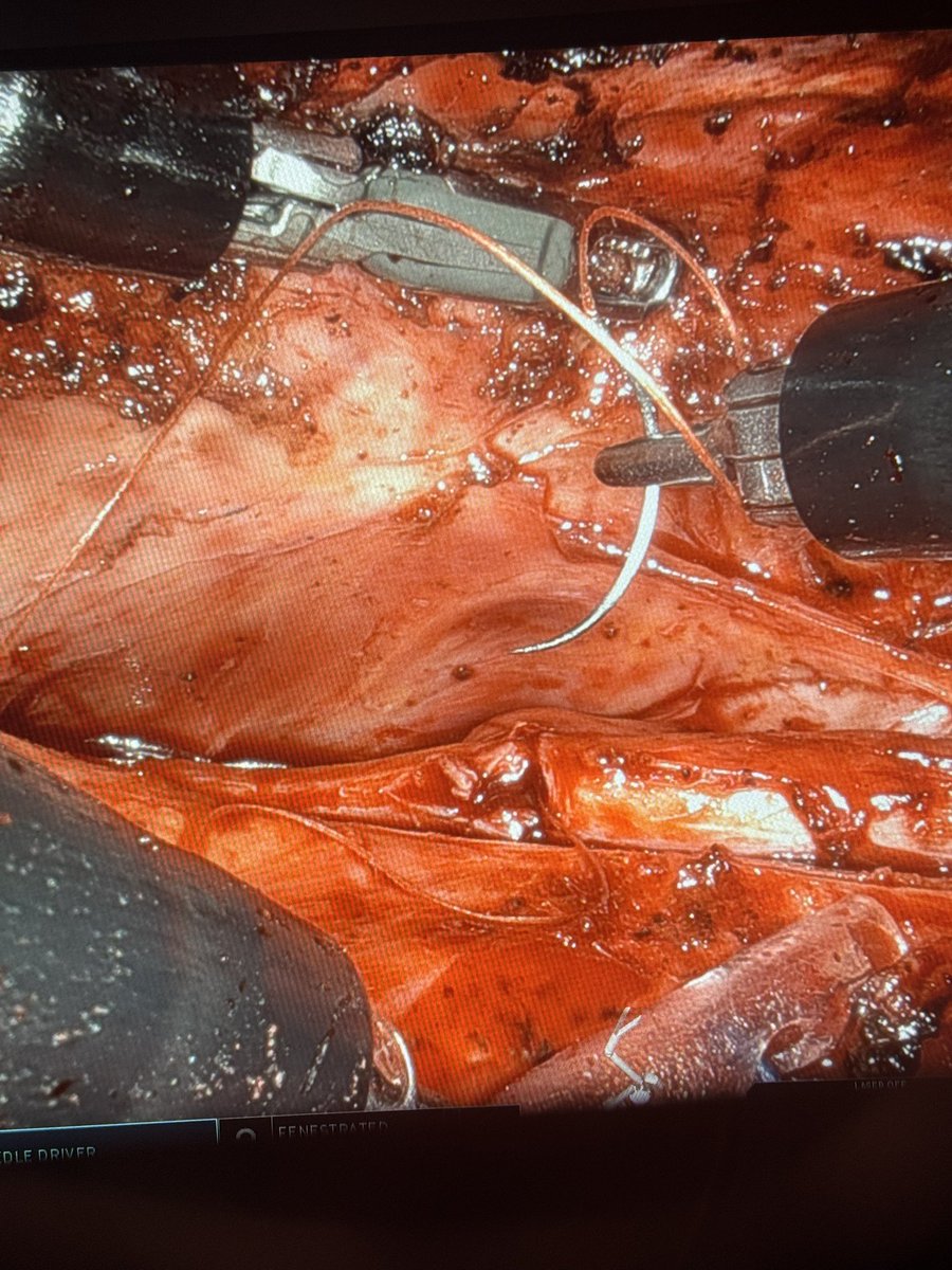 As I always say, having different robotic approach options is good. Here a radiation induced (prostate cancer) distal ureteral stricture in a man with a hostile abdomen from 8 bowel surgeries. Good time for a retroperitoneal LAA approach with Single port #robot <a href="/MountSinaiNYC/">Mount Sinai Health System</a>