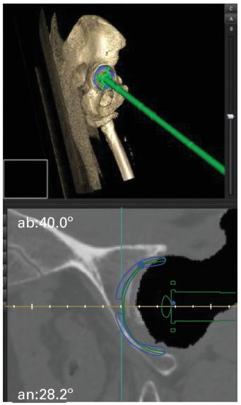 MoAImam's tweet image. Robotic-assisted surgery enhances the precision of component placement, significantly lowering the incidence of noise-related complications compared to conventional manual methods of total hip arthroplasty.

#Arthroplasty #HipReplacement #RoboticSurgery

ow.ly/MIOB50VrATE