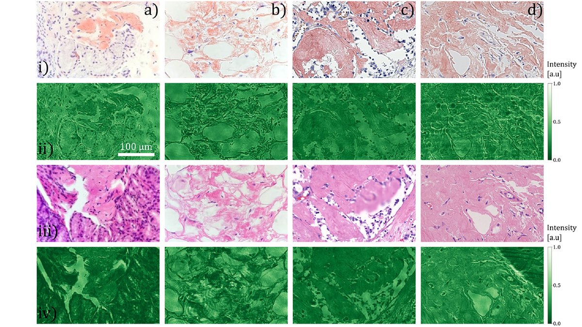 OpticaPubsGroup's tweet image. An Editors&apos; Pick via #OPG_BOEx: Quantitative diagnosis of amyloid without Congo red staining using polarized light microscopy bit.ly/4dN29tB #Birefringence #FourierSignalHarmonics @UWaterloo