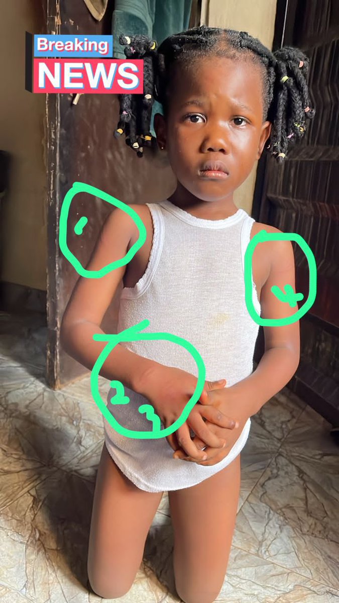IbkforMercy's tweet photo. These are where the cane marks are. The picture he posted was also edited on the arms and legs. They were smoothen out to hide the cane marks. Compare the arms and legs to her face, you will see the difference. 
It is well. https://t.co/emGnI3FPv4