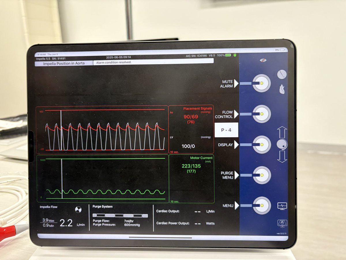 Alix Barnes (@alixb8) on Twitter photo Next up: Impella Management
๐จSuction Alarms?
Think LV preload versus improper positioning
โ๏ธ Check position with echo
โ๏ธ If position okay, can decrease P level or give volume. Also consider RV fxn as etiology of reduced LV preload!
#CCCES25 <a href="/UMN_CCCEdSummit/">UMN Critical Care Cardiology Education Summit</a> <a href="/CardioNerds/">CardioNerds</a> Next up: Impella Management
๐จSuction Alarms?
Think LV preload versus improper positioning
โ๏ธ Check position with echo
โ๏ธ If position okay, can decrease P level or give volume. Also consider RV fxn as etiology of reduced LV preload!
#CCCES25 <a href="/UMN_CCCEdSummit/">UMN Critical Care Cardiology Education Summit</a> <a href="/CardioNerds/">CardioNerds</a>