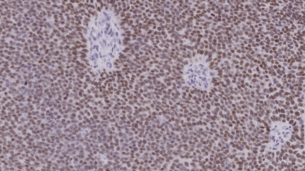 U-M Rogel Cancer Center (@umrogelcancer) on Twitter photo .<a href="/AlumkalJoshi/">Alumkal Lab</a> lab finds PROX1 drives aggressive, treatment-resistant prostate cancer. The gene can be indirectly targeted with HDAC inhibitors, suggesting a potential treatment strategy for patients with aggressive subtypes of prostate cancer: michmed.org/XWGjn .<a href="/AlumkalJoshi/">Alumkal Lab</a> lab finds PROX1 drives aggressive, treatment-resistant prostate cancer. The gene can be indirectly targeted with HDAC inhibitors, suggesting a potential treatment strategy for patients with aggressive subtypes of prostate cancer: michmed.org/XWGjn