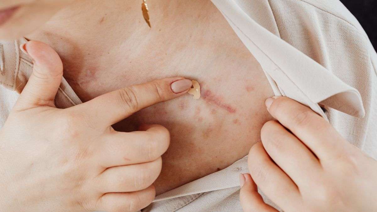 Estetic (@estetic_es) on Twitter photo #Bienestar | ¿Cómo mejorar estéticamente las #cicatrices post-quirúrgicas?
🗣️En palabras de la <a href="/DraEjimenez/">Clínica Elena Jiménez</a>: "La genética del paciente, la colocación estratégica de la cicatriz o el tipo de sutura empleado" son elementos cruciales"
consalud.es/estetic/bienes… #Bienestar | ¿Cómo mejorar estéticamente las #cicatrices post-quirúrgicas?
🗣️En palabras de la <a href="/DraEjimenez/">Clínica Elena Jiménez</a>: "La genética del paciente, la colocación estratégica de la cicatriz o el tipo de sutura empleado" son elementos cruciales"
consalud.es/estetic/bienes…