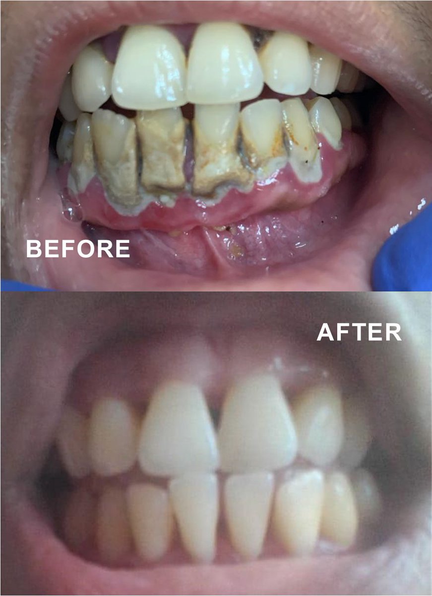 thetooth_dr's tweet photo. The before photo is of a patient who had plaque and calculus buildup. The after photo was the result of a scaling and root planning procedure.

#flossdental #thetoothdr #flossboss #beforeandafter #plaque #calculus #scaling #rootplaning #dentist #dentistry #trinidadandtobago https://t.co/dsVJBIGEgg