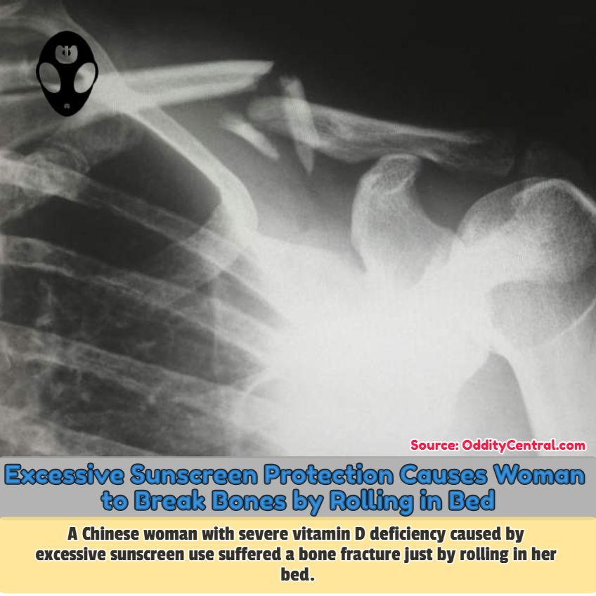 Chinese doctors recently reported the unusual case of a 48-year-old local woman 👩 who had apparently suffered a bone 🦴 fracture just by casually rolling in bed 🛏️. 

odditycentral.com/news/excessive… 

#accidents #vitaminD #bonefracture #medicaloddities #health #odditycentral