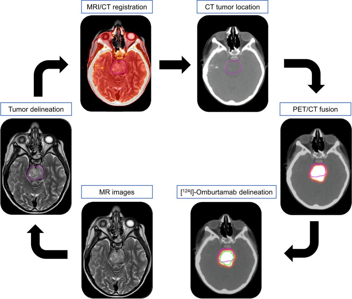 JNM (@journalofnucmed) on Twitter photo Convection-enhanced delivery of ¹²⁴I-Omburtamab is a novel approach for delivering radiolabeled therapies into brain-stem tumors. Read more: ow.ly/7jLp50VSPO3
#NuclearMedicine #Theranostics #BrainCancer <a href="/DrSouweidane/">Mark Souweidane, MD</a> <a href="/Alarsen27/">Alexandra Giantini Larsen, MD</a> Convection-enhanced delivery of ¹²⁴I-Omburtamab is a novel approach for delivering radiolabeled therapies into brain-stem tumors. Read more: ow.ly/7jLp50VSPO3
#NuclearMedicine #Theranostics #BrainCancer <a href="/DrSouweidane/">Mark Souweidane, MD</a> <a href="/Alarsen27/">Alexandra Giantini Larsen, MD</a>