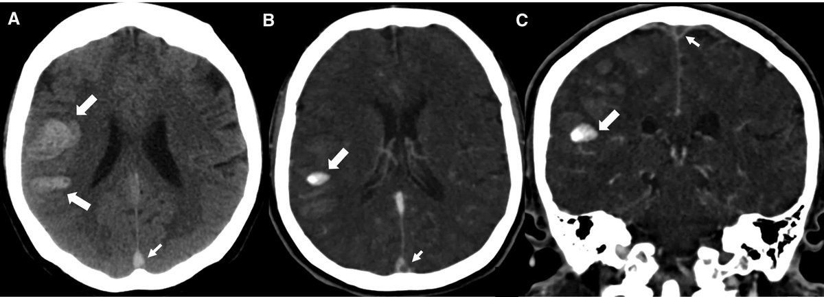 #Stroke Image showcases the "spot sign" in a case of intracerebral hemorrhage associated with cerebral venous sinus thrombosis. #AHAJournals ahajrnls.org/3ZiHLdF