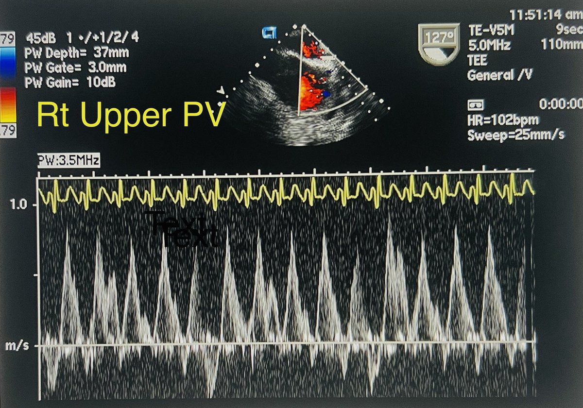CASivaram1's tweet photo. #echofirst
✅ Pulsed Doppler, Rt upper PV, TEE
✅ Comments? Sorry, don’t have a respiratory marker 
✅ More images to follow
@argulian 
@iamritu 
@ThelsaW 
@PWesslyMD 
@DrRajeshG1 https://t.co/e48jB9JrBV