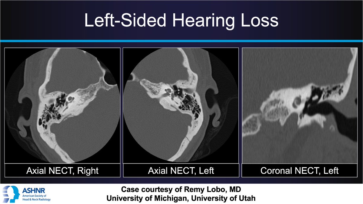 ASHNR (@ashnrsociety) on Twitter photo #ASHNRCOTW #299: Hearing loss. Thx <a href="/remyrlobo/">Remy Lobo</a> 4 case! #ASHNR25
Answer w/ appropriate GIF only -- stay professional & don't spoil it!
<a href="/callyrobs/">Caroline Robson, MBChB</a> <a href="/DShatzkes/">Deborah Shatzkes</a> <a href="/CDP_Rad/">C Douglas Phillips 🇺🇸</a> <a href="/rhwiggins/">Richard Wiggins</a>
<a href="/nakoontz/">Nicholas Koontz</a> <a href="/KRileyMD/">Kalen Riley</a> <a href="/CMGlastonbury/">Christine M Glastonbury, MD</a> <a href="/tabby_kennedy/">Tabby A. Kennedy, MD</a> <a href="/PhilipRChapman1/">Philip R. Chapman, MD</a> <a href="/cmtomblinson/">Courtney Tomblinson, MD</a>
<a href="/amyfjuliano/">Amy Juliano</a> #ASHNRCOTW #299: Hearing loss. Thx <a href="/remyrlobo/">Remy Lobo</a> 4 case! #ASHNR25
Answer w/ appropriate GIF only -- stay professional & don't spoil it!
<a href="/callyrobs/">Caroline Robson, MBChB</a> <a href="/DShatzkes/">Deborah Shatzkes</a> <a href="/CDP_Rad/">C Douglas Phillips 🇺🇸</a> <a href="/rhwiggins/">Richard Wiggins</a>
<a href="/nakoontz/">Nicholas Koontz</a> <a href="/KRileyMD/">Kalen Riley</a> <a href="/CMGlastonbury/">Christine M Glastonbury, MD</a> <a href="/tabby_kennedy/">Tabby A. Kennedy, MD</a> <a href="/PhilipRChapman1/">Philip R. Chapman, MD</a> <a href="/cmtomblinson/">Courtney Tomblinson, MD</a>
<a href="/amyfjuliano/">Amy Juliano</a>