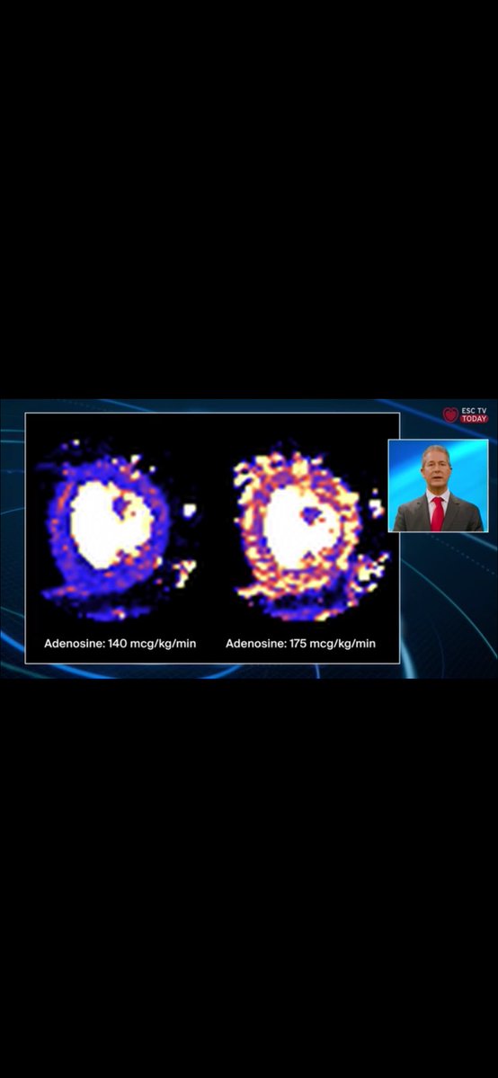 EACVI President (@eacvipresident) on Twitter photo Immediate Past <a href="/EACVIPresident/">EACVI President</a> <a href="/s_e_petersen/">Steffen Petersen</a> presents a quantitative cardiac MRI perfusion scan and how to avoid pitfalls in interpretation on <a href="/escardio/">European Society of Cardiology</a> TV 📺
<a href="/VDelgadoGarcia/">Victoria Delgado</a> <a href="/denisamuraru/">Denisa Muraru</a> <a href="/rmanka_/">Robert Manka</a> <a href="/RNijveldt/">Robin Nijveldt</a> <a href="/drniallkeenan/">Dr Niall Keenan</a> <a href="/AnnaBaritussio/">Anna Baritussio</a> <a href="/AnnaKateBarton/">Anna Kate Barton</a> <a href="/carpenter_jp/">JP Carpenter</a> Immediate Past <a href="/EACVIPresident/">EACVI President</a> <a href="/s_e_petersen/">Steffen Petersen</a> presents a quantitative cardiac MRI perfusion scan and how to avoid pitfalls in interpretation on <a href="/escardio/">European Society of Cardiology</a> TV 📺
<a href="/VDelgadoGarcia/">Victoria Delgado</a> <a href="/denisamuraru/">Denisa Muraru</a> <a href="/rmanka_/">Robert Manka</a> <a href="/RNijveldt/">Robin Nijveldt</a> <a href="/drniallkeenan/">Dr Niall Keenan</a> <a href="/AnnaBaritussio/">Anna Baritussio</a> <a href="/AnnaKateBarton/">Anna Kate Barton</a> <a href="/carpenter_jp/">JP Carpenter</a>