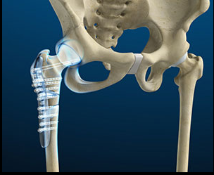 DrRobClemens's tweet photo. Regional and General Anesthesia for Hip Fracture Surgery Show Similar Cognitive Outcomes in New Study
https://t.co/Y9d17nrNTG
#anesthesia #regional #general #hip #fracture #hipfracture #surgery #hipsurgery #congitive #outcomes #study https://t.co/ZcmhWXrIFP