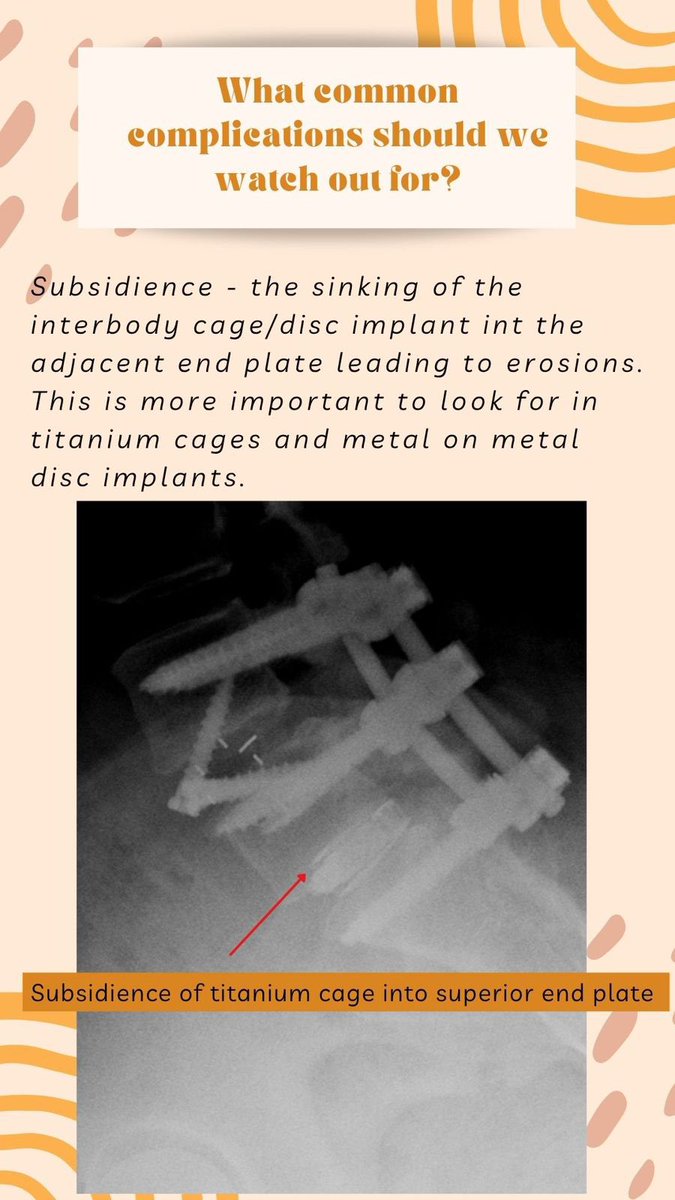 MSS India (@msksocietyindia) on Twitter photo MSK RADIOLOGY FOR EVERYONE, continuing with Episode 2: Assessing lumbar radiographs post spine fixation.
. Hope this helps!
#msk #mskRad #FOAMRad #FOAMMed #radiology #RadRes #medicine #orthotwitter #MSKImaging #Radiology #Education #Musculoskeletal #FoamRad #medtwitter
<a href="/samrad77/">Sameer Raniga</a> MSK RADIOLOGY FOR EVERYONE, continuing with Episode 2: Assessing lumbar radiographs post spine fixation.
. Hope this helps!
#msk #mskRad #FOAMRad #FOAMMed #radiology #RadRes #medicine #orthotwitter #MSKImaging #Radiology #Education #Musculoskeletal #FoamRad #medtwitter
<a href="/samrad77/">Sameer Raniga</a>