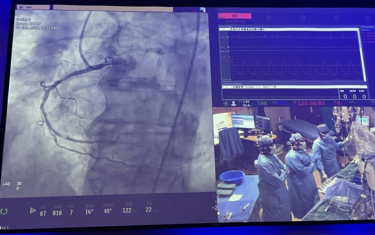 Live case 2:

Calcified diffuse disease 

Focal lesion distal RCA

CCTA 
CT-FFR