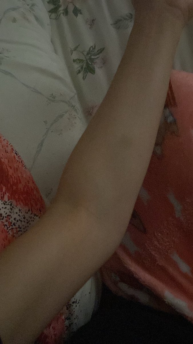 Arm check + bruise