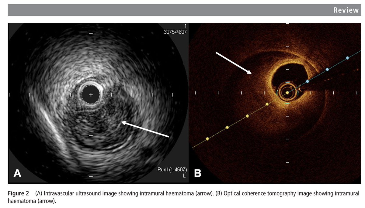 🔴 Contemporary diagnosis &amp; management of spontaneous coronary artery dissection <a href="/Heart_BMJ/">Heart_BMJ</a> #Cardiology #CardioEd #SCAD