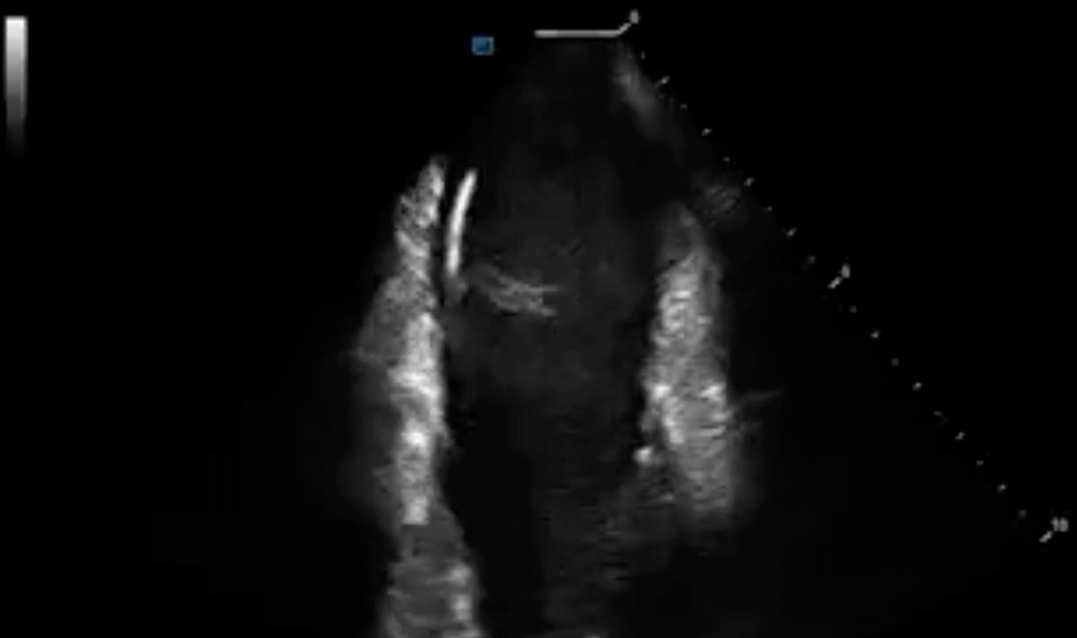 Fergie J. Losiniecki, MD, FACC, FHRS (@fergielosiniec1) on Twitter photo The <a href="/angiodynamics/">AngioDynamics, Inc.</a> #AlphaVac is truly redefining what's possible in managing masses and vegetations related to cardiac leads and extractions. Glad to have this technology in my toolbox! The <a href="/angiodynamics/">AngioDynamics, Inc.</a> #AlphaVac is truly redefining what's possible in managing masses and vegetations related to cardiac leads and extractions. Glad to have this technology in my toolbox!