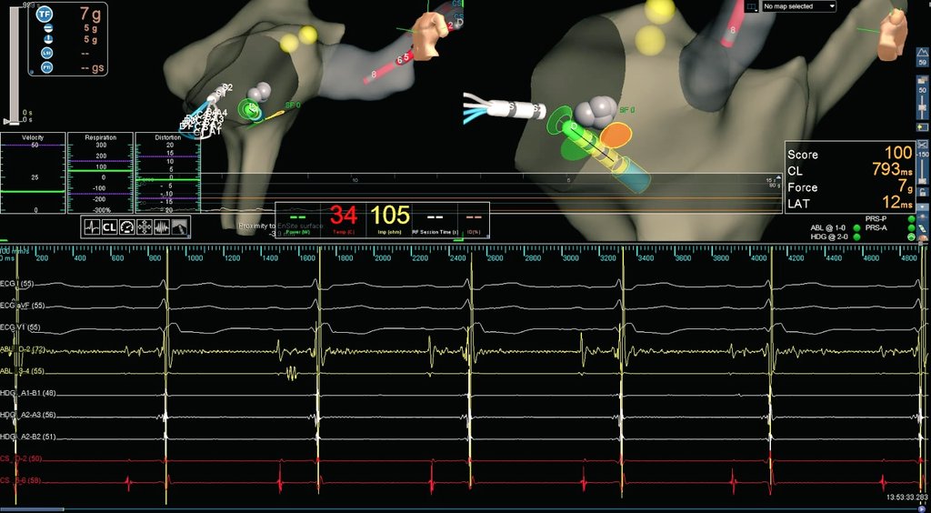 Nelson Polo Taborda (@nelsonpol) on Twitter photo 🔸Potencial de Haissaguerre (Baja frecuencia): Entre células transicionales y zona compacta de NAV.
🔸Potencial de Jackman (Alta frecuencia): Cerca del ostium del SC. Corresponde a la vía lenta. <a href="/AThomazAndrade/">Antonio Thomaz de Andrade, MD 🇧🇷</a> <a href="/ErnestoMD2615/">Ernesto Barrantes</a> <a href="/MosqueaRubelin/">Dr. Rubelin mosquea</a> <a href="/melhamriti/">El Hamriti Mustapha</a> <a href="/fvassallomd/">Fabricio Vassallo, MD, PhD</a> <a href="/TomasDatino/">@TomasDatino</a> 🔸Potencial de Haissaguerre (Baja frecuencia): Entre células transicionales y zona compacta de NAV.
🔸Potencial de Jackman (Alta frecuencia): Cerca del ostium del SC. Corresponde a la vía lenta. <a href="/AThomazAndrade/">Antonio Thomaz de Andrade, MD 🇧🇷</a> <a href="/ErnestoMD2615/">Ernesto Barrantes</a> <a href="/MosqueaRubelin/">Dr. Rubelin mosquea</a> <a href="/melhamriti/">El Hamriti Mustapha</a> <a href="/fvassallomd/">Fabricio Vassallo, MD, PhD</a> <a href="/TomasDatino/">@TomasDatino</a>