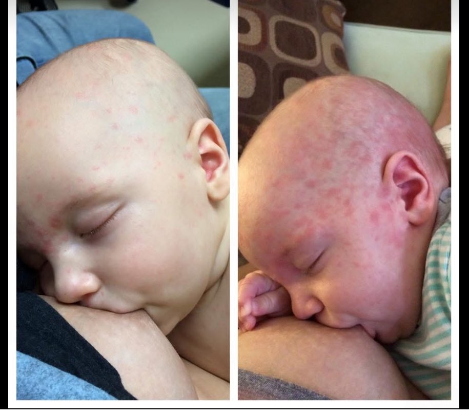 Гадуур улаан бурхан аймаар байна.
Вакцин эсэргүүцээд байсан авгайг үндэсний эсрэг хортой суртал явуулга явуулсан гэж жинхэнэ барьж хоримоор байна🤬🤬🤬
Эмч нар аргаа барж байна шдээ