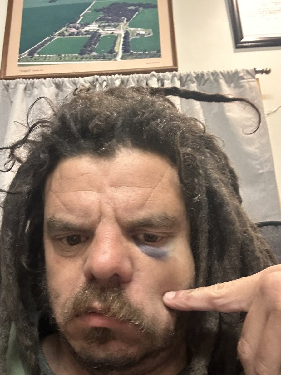 Wish I could say “you should see the other guy” but when it’s metal it’s doesn’t tend to hurt the other bloke mode than you 🤣🤣