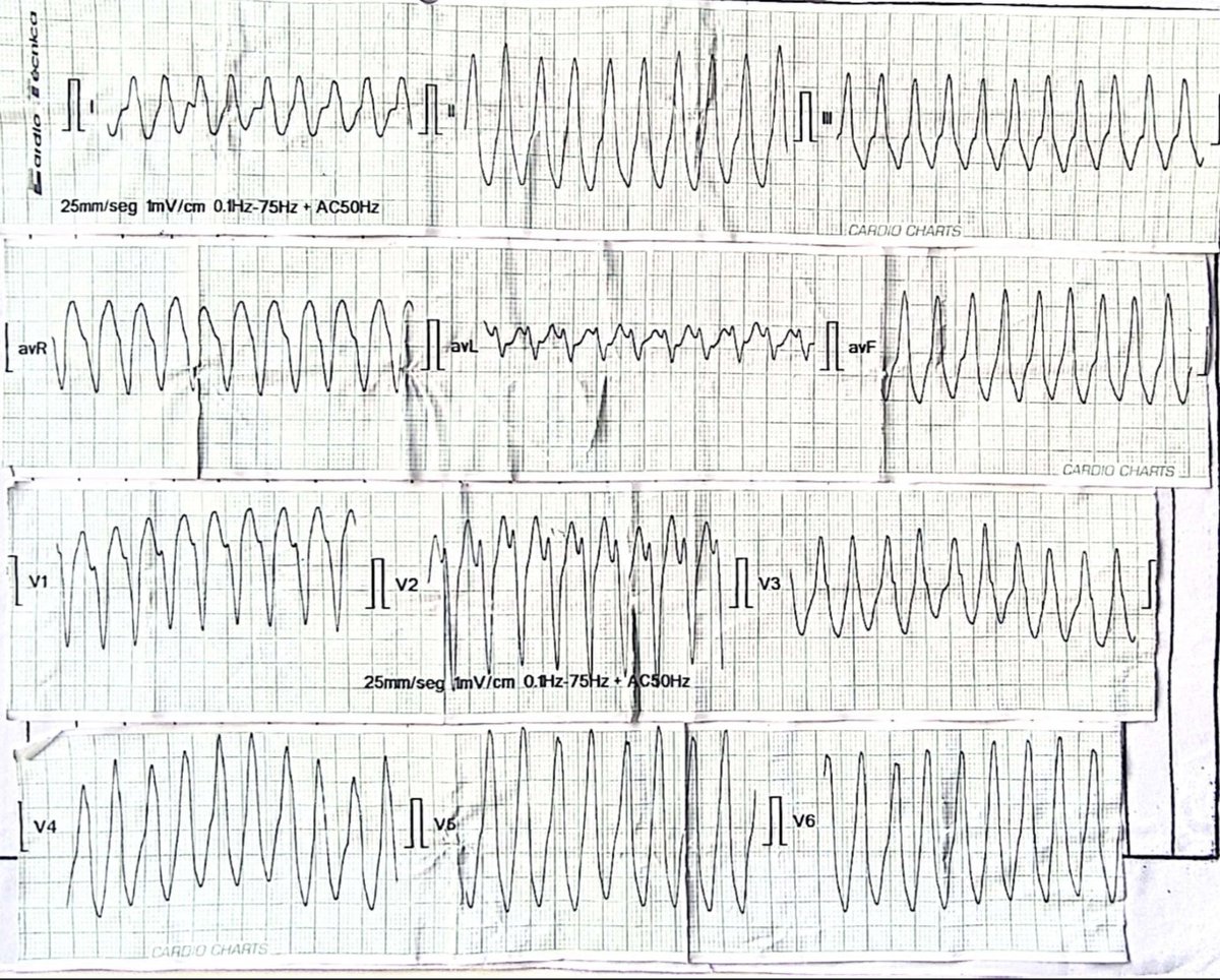 Nelson Polo Taborda (@nelsonpol) on Twitter photo 👨🏻57 y/o. History: DM2, Hta. ER: Chest pain + palpitations. Eco♥️: IVS 13mm, EF 39%, basal hypocinesia. Cath: normal. <a href="/AThomazAndrade/">Antonio Thomaz de Andrade, MD 🇧🇷</a> <a href="/ErnestoMD2615/">Ernesto Barrantes</a> <a href="/ecgrhythms/">Arnel Carmona</a> <a href="/ecgandrhythmRoe/">Dr. Andreas Roeschl</a> <a href="/DrRazi4/">Dr Razi</a> <a href="/laubaquerob/">Laura Baquero</a> <a href="/Carlos_Penate6/">Carlos M. Peñate, MD</a> <a href="/ECGEPSCADEVICE/">色々自粛中(ガラス細工の様な繊細なハートを持つ貴公子🤴)サブ垢です🙇♂️</a> #EPeeps 👨🏻57 y/o. History: DM2, Hta. ER: Chest pain + palpitations. Eco♥️: IVS 13mm, EF 39%, basal hypocinesia. Cath: normal. <a href="/AThomazAndrade/">Antonio Thomaz de Andrade, MD 🇧🇷</a> <a href="/ErnestoMD2615/">Ernesto Barrantes</a> <a href="/ecgrhythms/">Arnel Carmona</a> <a href="/ecgandrhythmRoe/">Dr. Andreas Roeschl</a> <a href="/DrRazi4/">Dr Razi</a> <a href="/laubaquerob/">Laura Baquero</a> <a href="/Carlos_Penate6/">Carlos M. Peñate, MD</a> <a href="/ECGEPSCADEVICE/">色々自粛中(ガラス細工の様な繊細なハートを持つ貴公子🤴)サブ垢です🙇♂️</a> #EPeeps