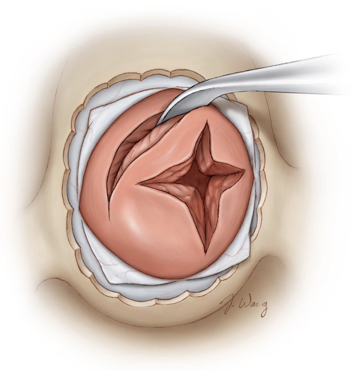 In the case of Cushing’s disease and in select cases, the wall of the resection cavity may be removed and pathologically examined. This maneuver may improve the odds of complete endocrine remission.

Learn more here: zurl.co/d0m11 

 #Neurosurgery #EndoscopicSurgery