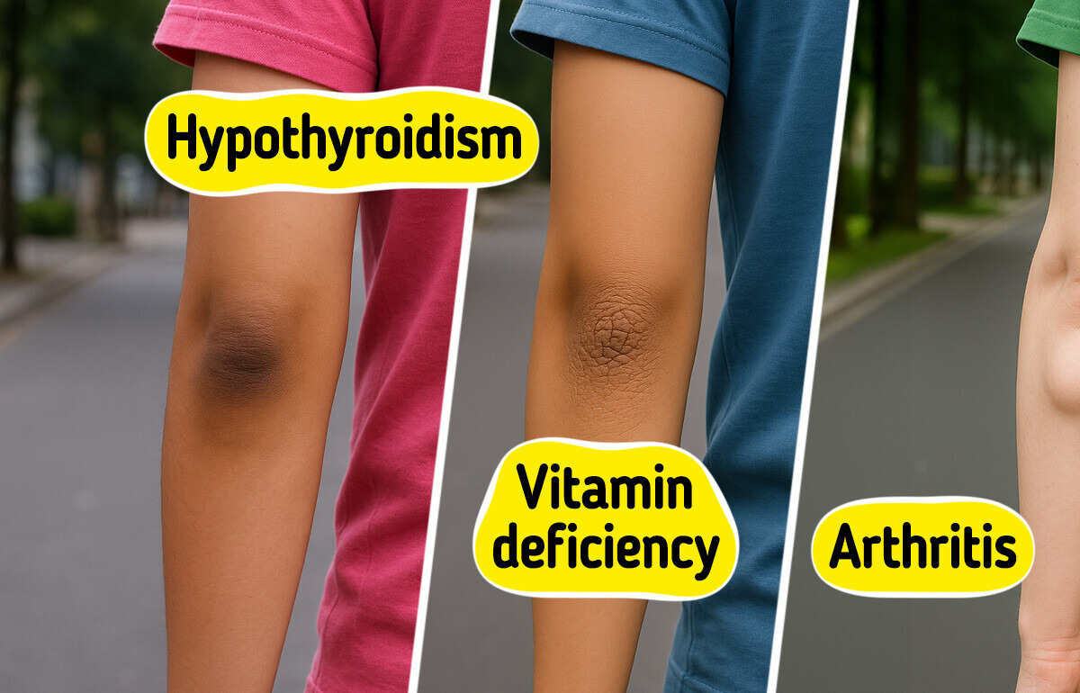 BorcdPanda's tweet photo. 10 Common Elbow Skin Issues That Could Reflect Underlying Health Problems
https://t.co/dy3sjInyRO
#Iglesias #Tesla #Hamilton #BallerinaMovie #Skin #ElbowsUpCanada #HealthTips #Underlying #Issues https://t.co/o8DNX8GqFN