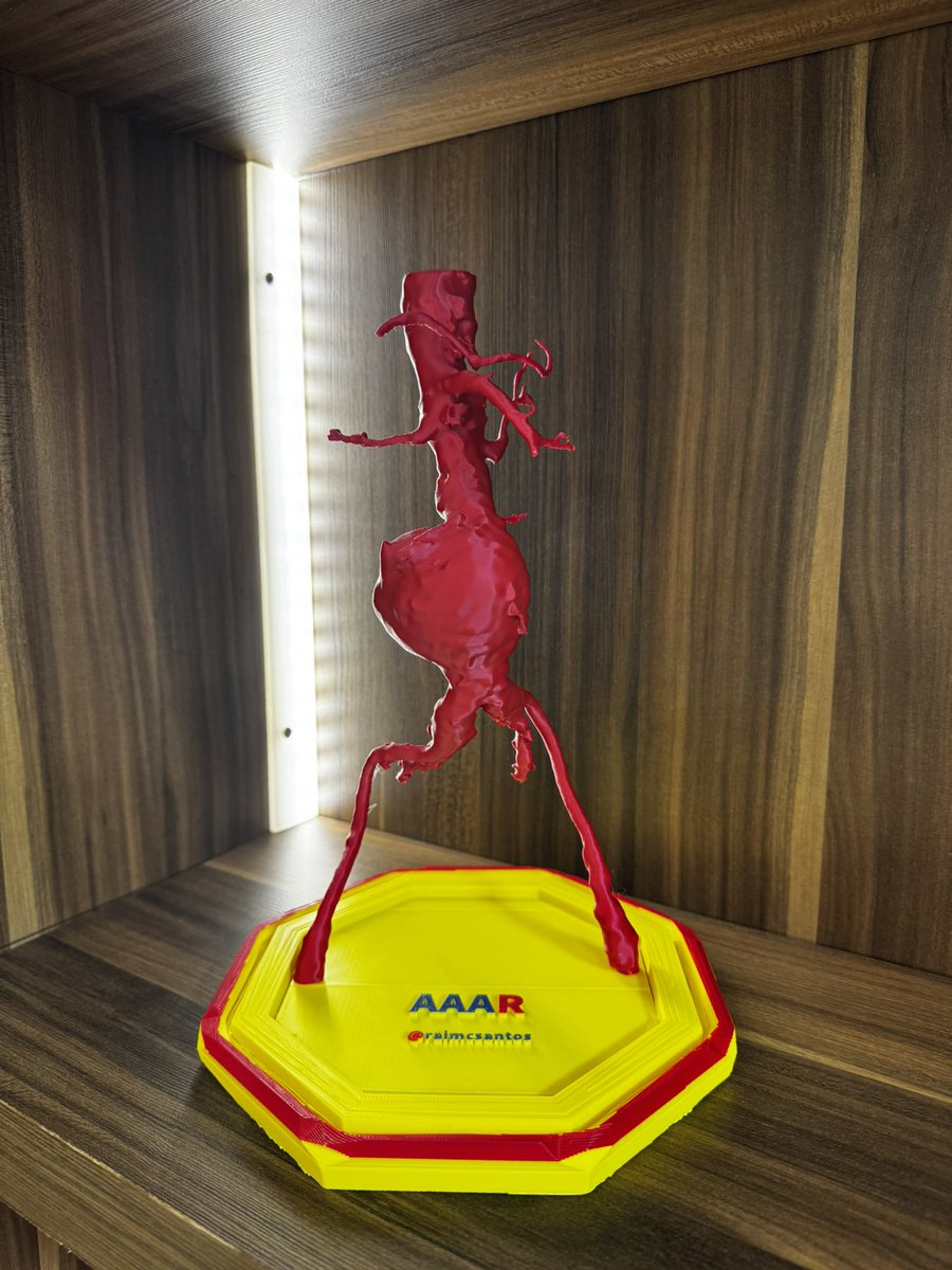 raimcsantos's tweet photo. Ruptured abdominal aortic aneurysm. Saccular aneurysm with involvement of all walls (6.2 cm diameter). This type of aneurysm is the most aggressive, especially when the posterior wall also dilates and degenerates.
#AortaEd #VascularEd #Vascular #Surgery #Aneurysm

Aneurisma de aorta abdominal rôto. Aneurisma sacular com comprometimento de todas as paredes.(6,2 cm diâmetro). Este formato de aneurisma é o mais agressivo, principalmente quando a parede posterior também dilata e degenera.