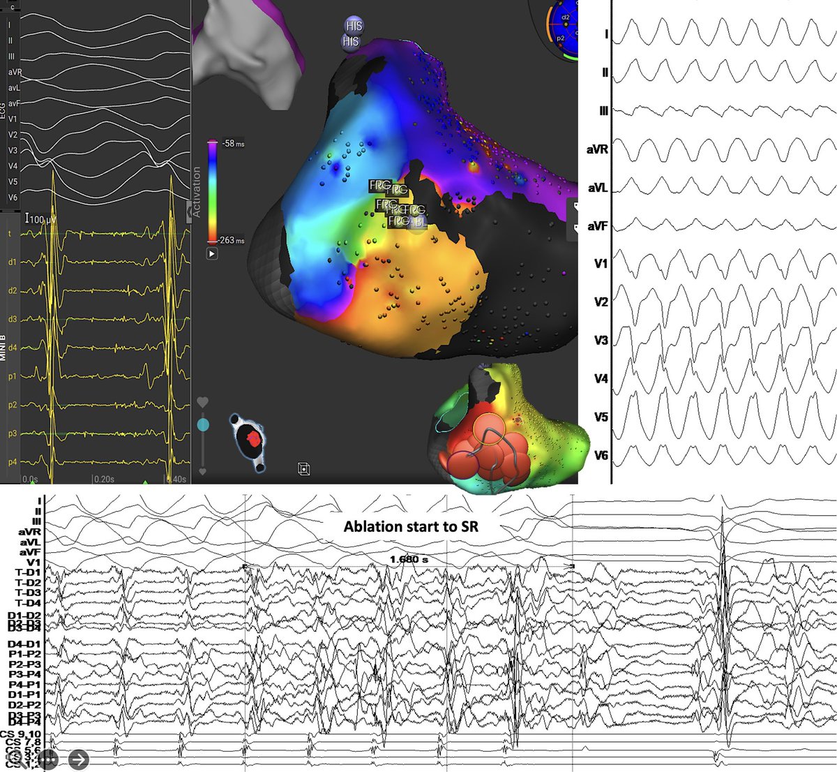 Michail Efremidis (@mefraimidis) on Twitter photo Basal septal VT in a pt with ICM was ablated using AFFERA system. A diastolic pathway was identified, and VT terminated during RF application.<a href="/ipetemil/">Panagiotis Mililis</a> <a href="/SteliosDragasis/">Stelios</a> <a href="/Kariki_O/">Ourania Kariki</a> <a href="/athsaplaouras/">Athanasios Saplaouras</a> <a href="/K_Letsas/">Konstantinos Letsas</a> <a href="/PetrosSkalidis/">Petros Skalidis</a> Basal septal VT in a pt with ICM was ablated using AFFERA system. A diastolic pathway was identified, and VT terminated during RF application.<a href="/ipetemil/">Panagiotis Mililis</a> <a href="/SteliosDragasis/">Stelios</a> <a href="/Kariki_O/">Ourania Kariki</a> <a href="/athsaplaouras/">Athanasios Saplaouras</a> <a href="/K_Letsas/">Konstantinos Letsas</a> <a href="/PetrosSkalidis/">Petros Skalidis</a>