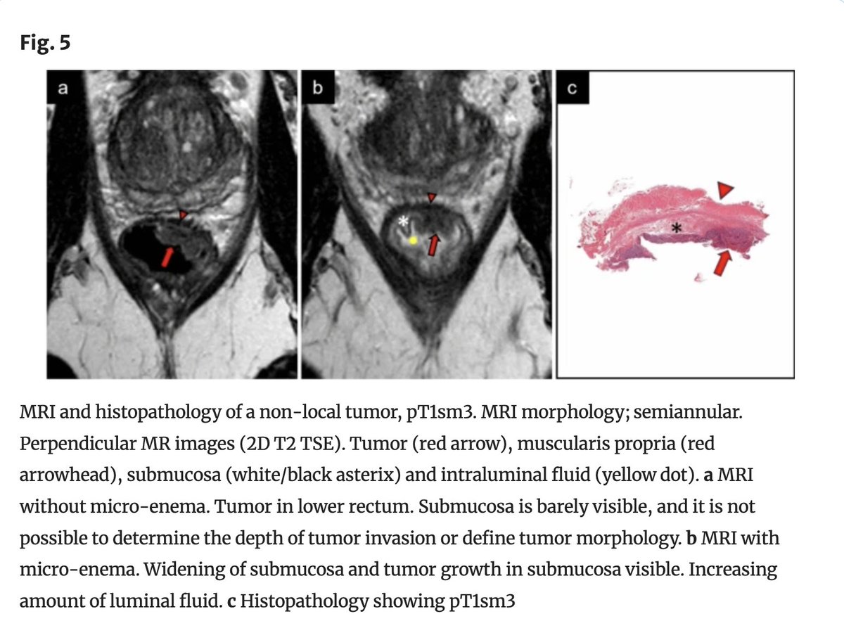 Abdominal_Rad's tweet image. MRI of early rectal cancer; bisacodyl micro-enema increases submucosal width, reader confidence, and tumor conspicuity.

Ellen Viktil et al

link.springer.com/article/10.100…

@LetDdiceFlyHigh
@RadGeek
#FOAMRad #radiology #radres #abdrad