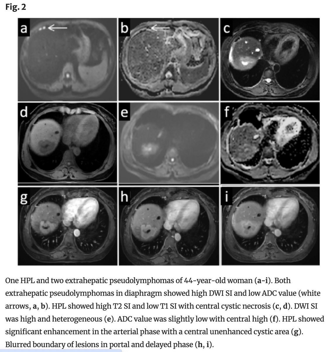 Abdominal_Rad's tweet image. MR imaging findings of hepatic pseudolymphoma: common and rare features

Xiaoer Zhao et al

link.springer.com/article/10.100…

@LetDdiceFlyHigh
@RadGeek
#FOAMRad #radiology #radres #abdrad