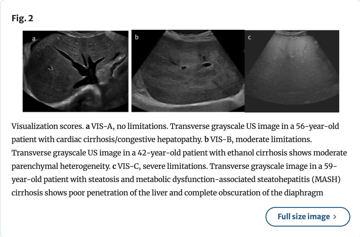 Abdominal_Rad's tweet image. Optimizing US for HCC surveillance

Shuchi Rodgers et al

link.springer.com/article/10.100…

@LetDdiceFlyHigh
@RadGeek
#FOAMRad #radiology #radres #abdrad