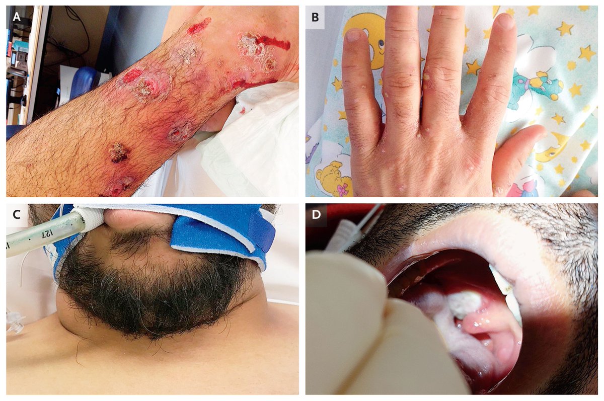 Original Article: 𝘊𝘰𝘳𝘺𝘯𝘦𝘣𝘢𝘤𝘵𝘦𝘳𝘪𝘶𝘮 𝘥𝘪𝘱𝘩𝘵𝘩𝘦𝘳𝘪𝘢𝘦 Outbreak in Migrant Populations in Europe nej.md/3HEF3ZS 

#IDTwitter #GlobalHealth